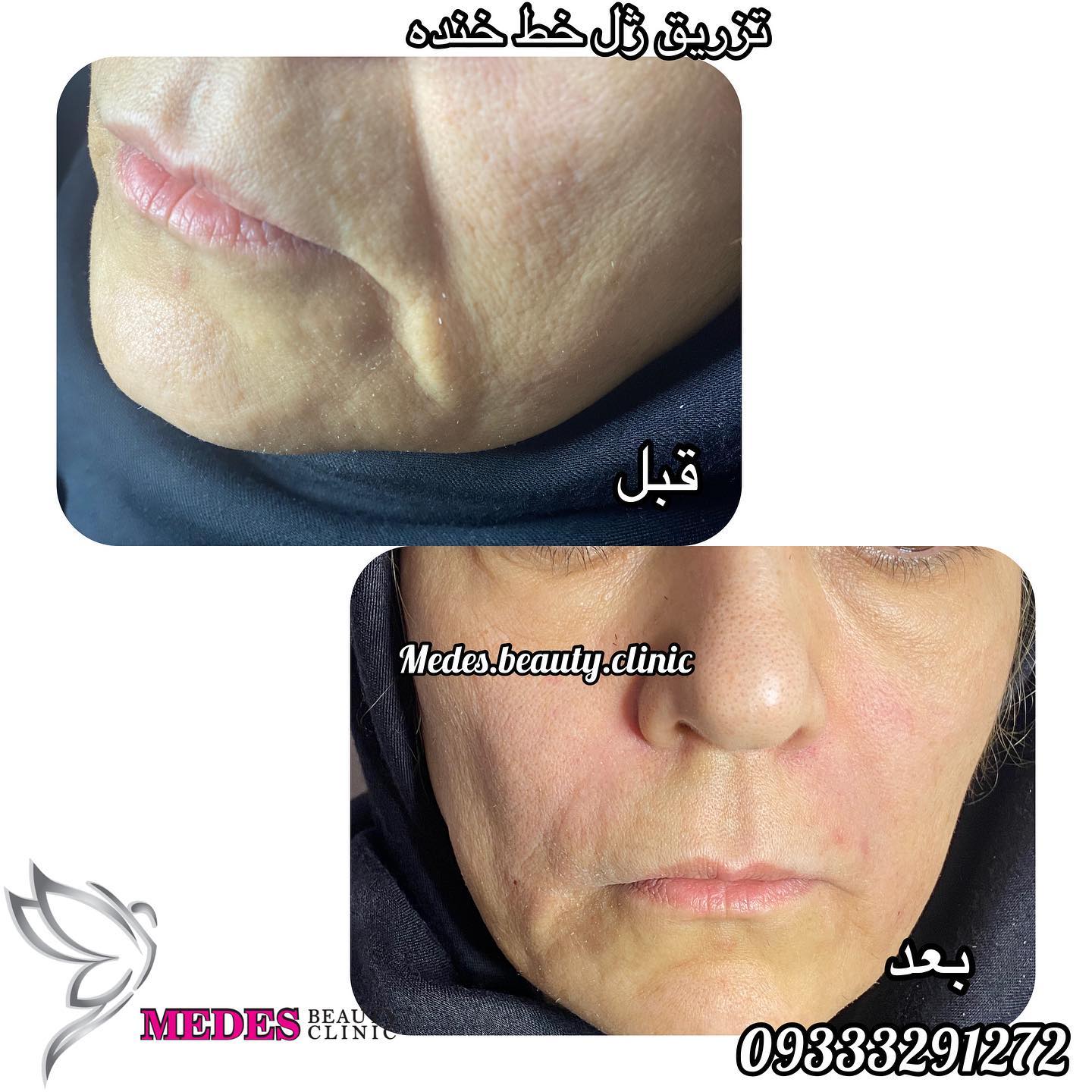 تزریق ژل خط خنده